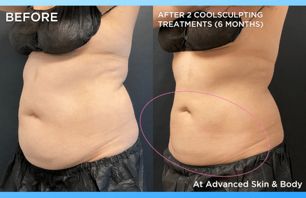 How to Tighten Loose Skin After Losing Weight - Cosmos Clinic